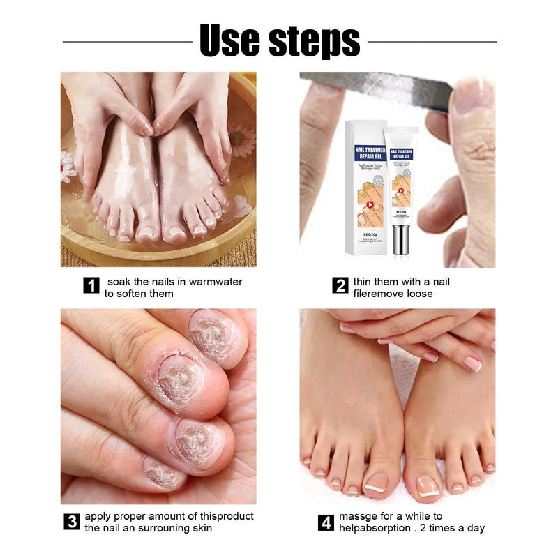 Creme da remoção de fungo, Tratamento do pé, Anti-infecção, Anti-Fungal, Onychomycosis, Paronychia - BrazilStory